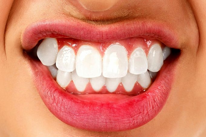 Sporting Smiles Nightguards Per Il Digrignamento Dei Denti Personalizzato